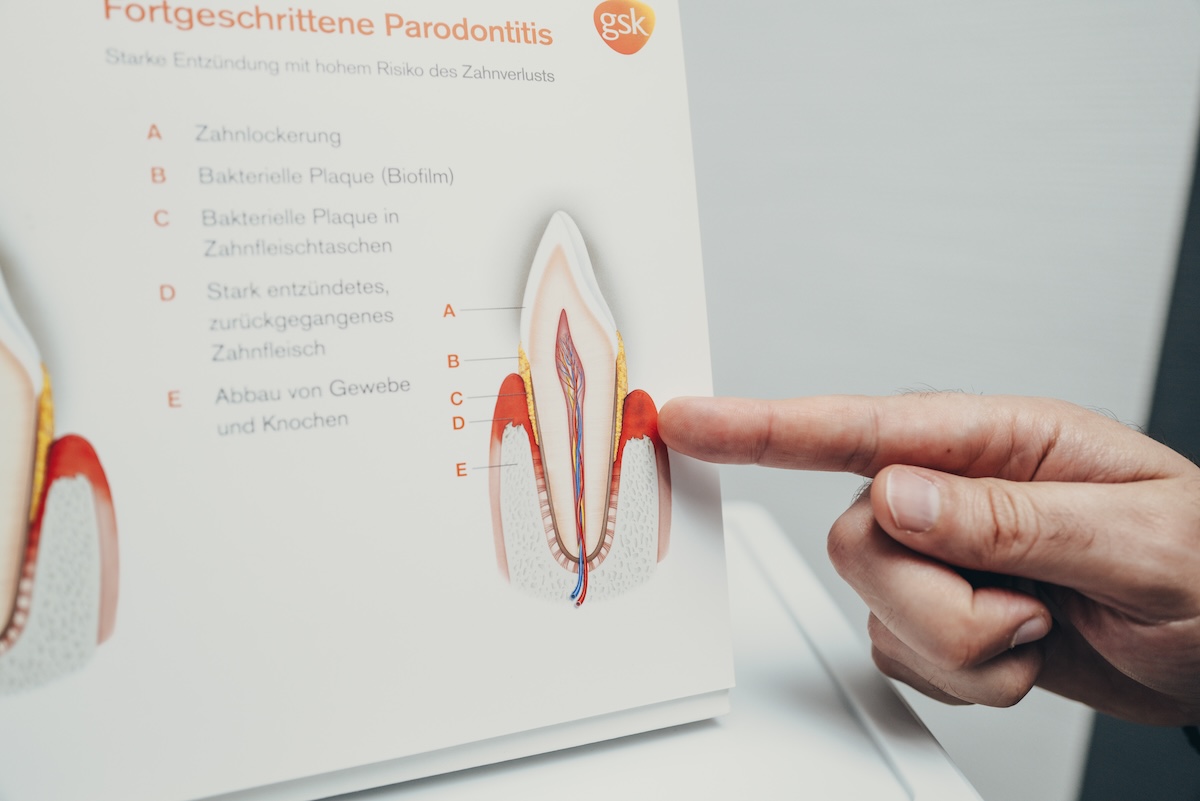 Eine männliche Hand zeigt mit dem Zeigefinger auf ein Schaubild einer fortgeschrittenen Parodontitis